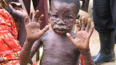 Democratic Republic of Congo Sees Worrying Rise in Monkeypox Cases