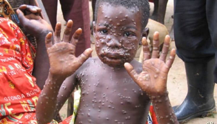 Democratic Republic of Congo Sees Worrying Rise in Monkeypox Cases